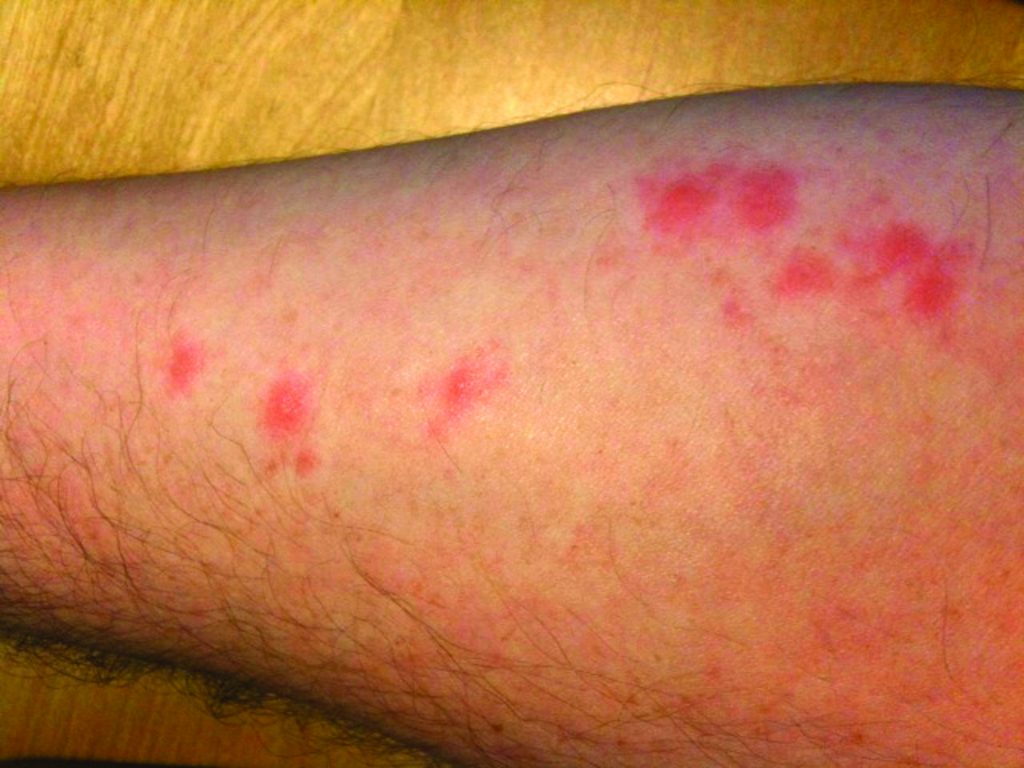 Bites from hungry bed bugs