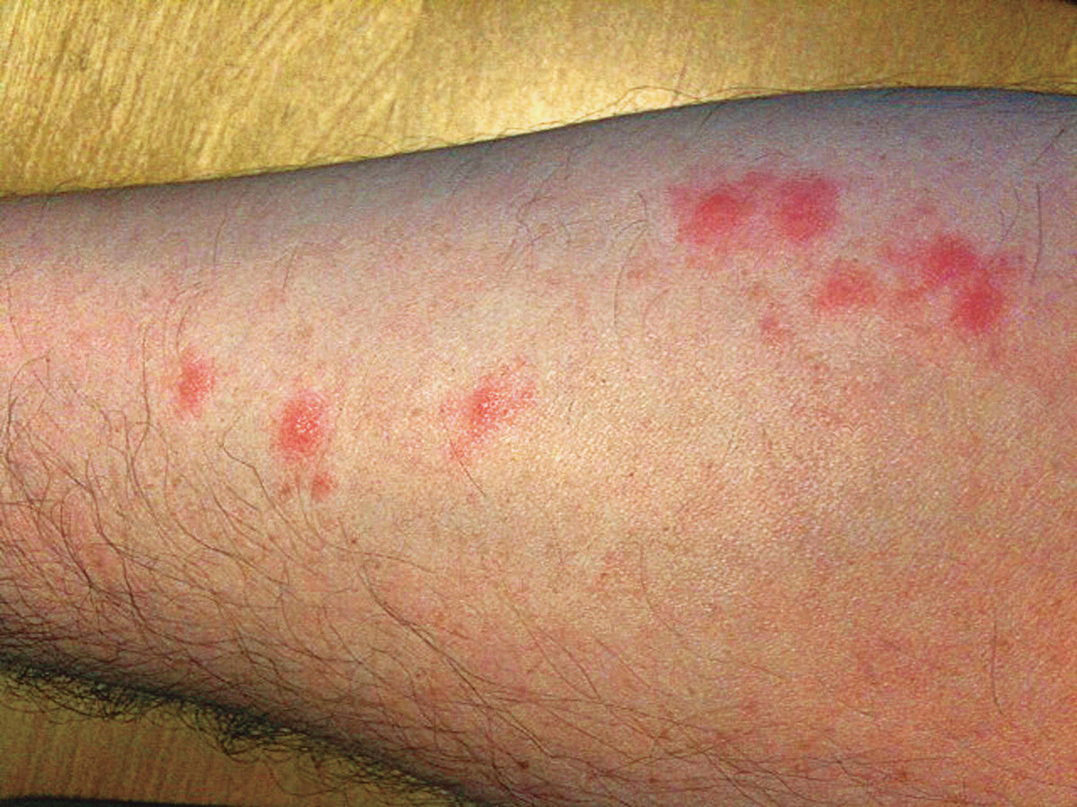 arm with red bed bug bites
